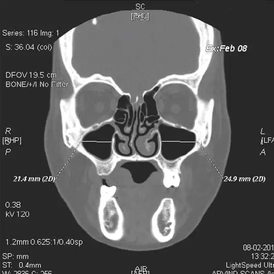 CT scan Maxilla Coronal